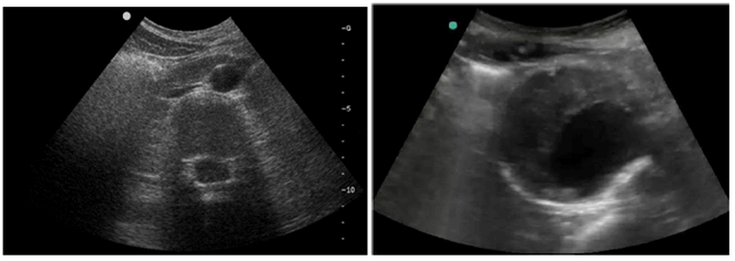 Copy of original 3GPP image for 3GPP TS 22.826, Fig. 5.3.2.1-1: Ultra-sound imagery of an abdominal aortic aneurysm (right hand side picture)